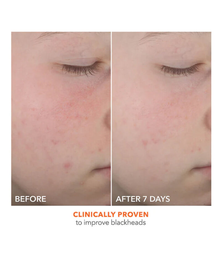 Dr Dennis Gross Alpha Beta On the Spot Eliminator 2% Salicylic Acid Acne Treatment Gel