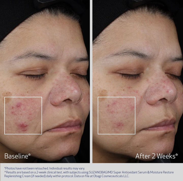 SUZANOBAGIMD™ Super Antioxidant Serum