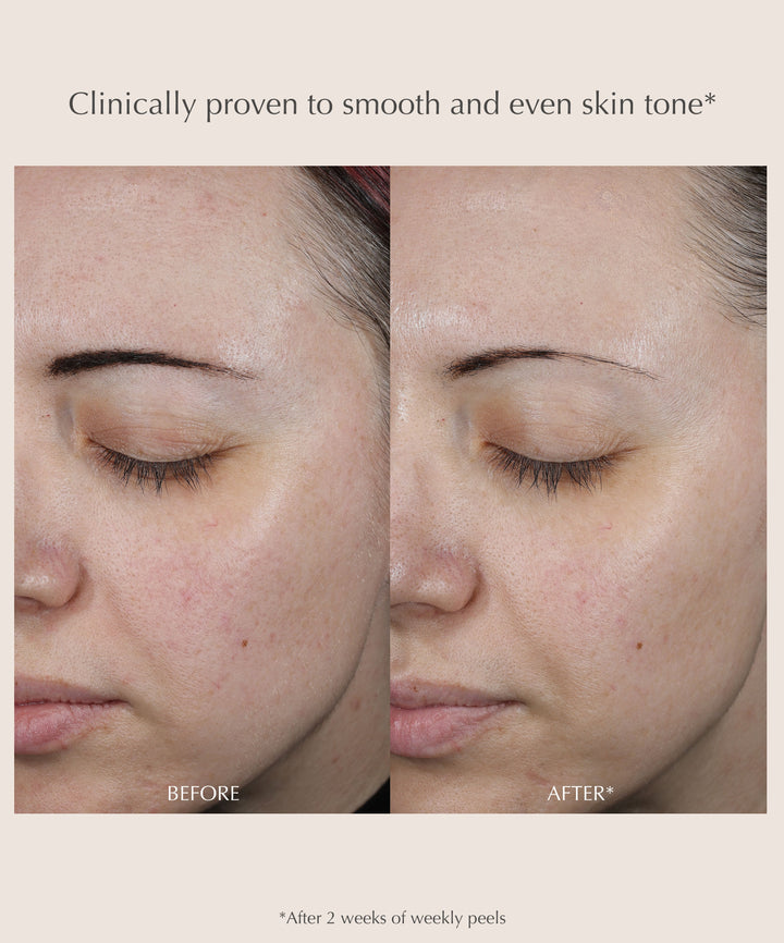 Exuviance Performance Peel AP25 At-Home Chemical Peel